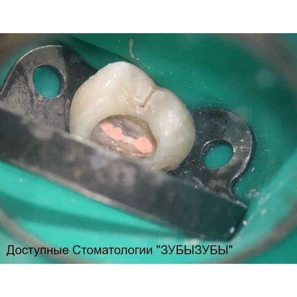 Пломбирование корневых каналов