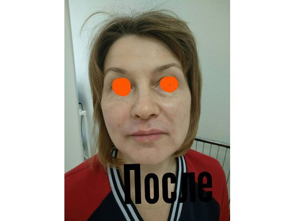 Эффект лифтинга кожи с помощью нитей изподиаксонона и жидких нитей с биозолотом Эффект лифтинга кожи с помощью нитей изподиаксонона и жидких нитей с биозолотом