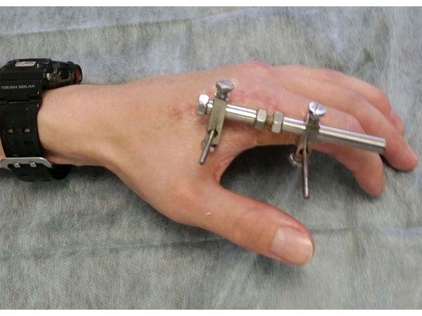 Этап лечения 1