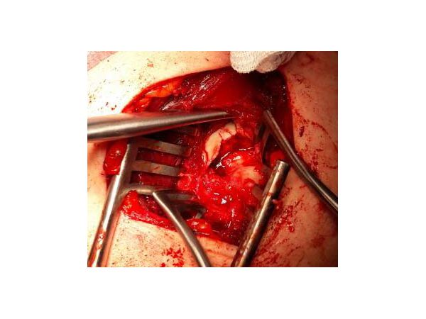 Дефект головки плечевой кости