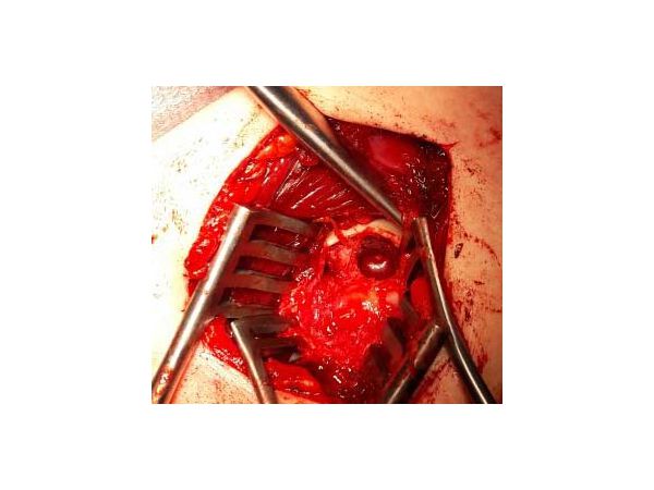 Подготовка места для костного трансплантата