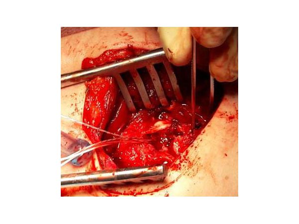 После установки костного трансплантата и анкера с лигатурами