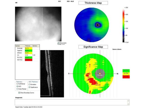 Данные ОКТ на момент первичного осмотра Данные ОКТ на момент первичного осмотра