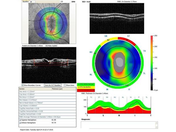 Данные ОКТ на момент первичного осмотра Данные ОКТ на момент первичного осмотра