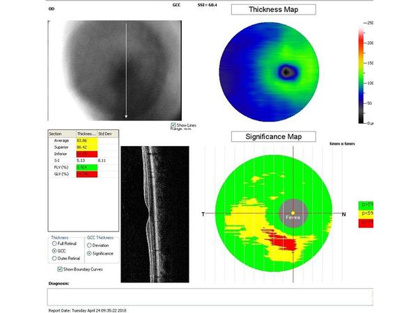Данные ОКТ через месяц после лазерного лечения Данные ОКТ через месяц после лазерного лечения