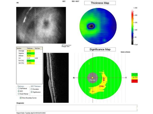 Данные ОКТ через месяц после лазерного лечения Данные ОКТ через месяц после лазерного лечения