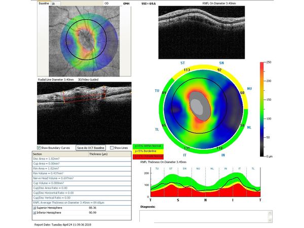 Данные ОКТ через месяц после лазерного лечения Данные ОКТ через месяц после лазерного лечения