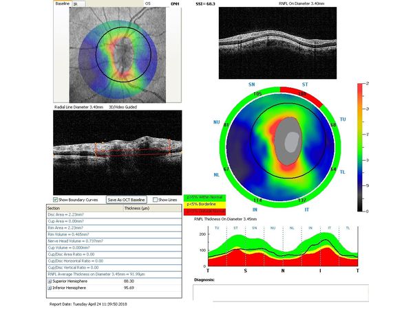 Данные ОКТ через месяц после лазерного лечения Данные ОКТ через месяц после лазерного лечения