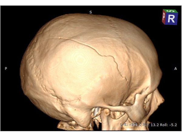 КТ с 3D реконструкцией до операции: линейный перелом правой теменной кости