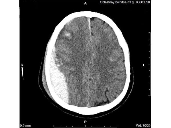 КТ до операции, аксиальный скан: эпидуральная гематома в правой теменной области головного мозга