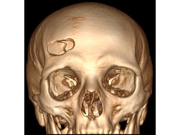 КТ с 3D реконструкцией после операции: трепанация черепа в лобной области