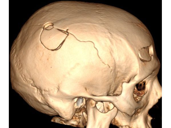 КТ с 3D реконструкцией после операции: трепанация черепа в правой теменной области