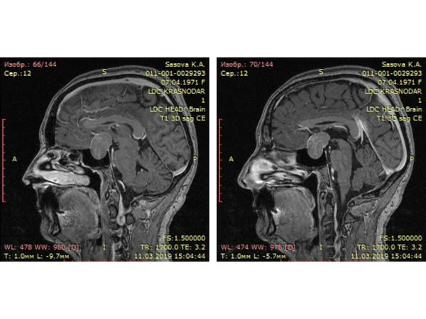 МРТ головного мозга: макроаденома гипофиза в боковой проекции
