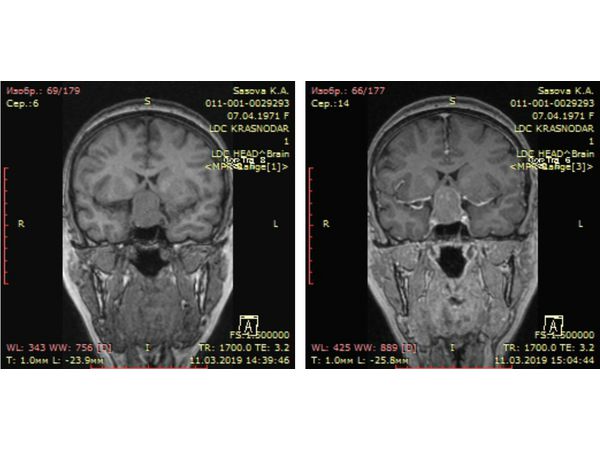 МРТ головного мозга: макроаденома гипофиза во фронтальной проекции