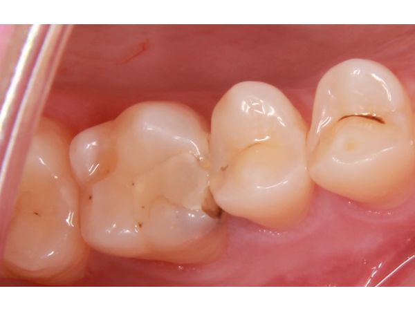 Зубы 1.6 и 1.5 до лечения