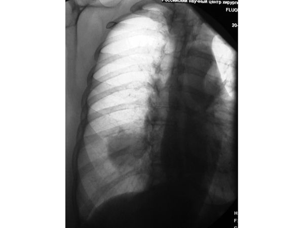 Рентгенограмма органов грудной клетки в косой проекции. Шаровидная тень новообразования в нижней доле правого лёгкого.