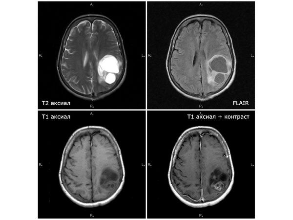 Кистозно глиозные изменения головного мозга что это. Глиобластома головного мозга симптомы. Глиобластома головного мозга прогноз.