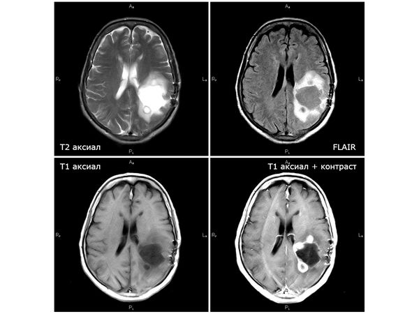 Больные глиобластомой фото
