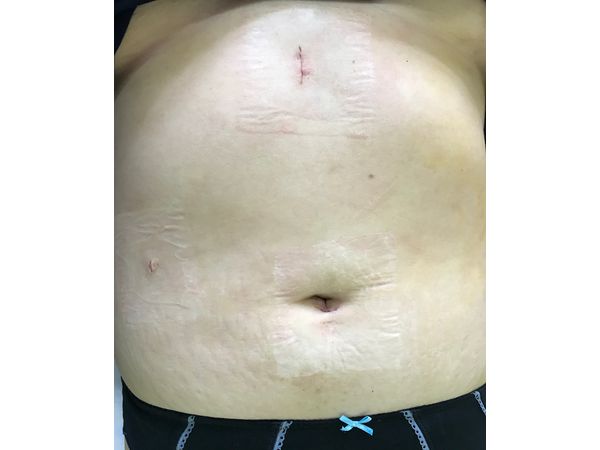 Первые сутки после лапароскопической операции