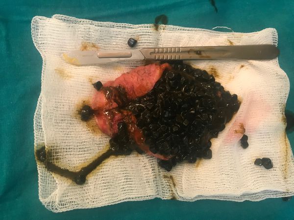 Содержимое желчного пузыря