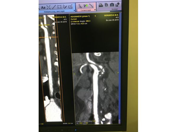 КТ-ангоиграфия: субокклюзия сонной артерии слева