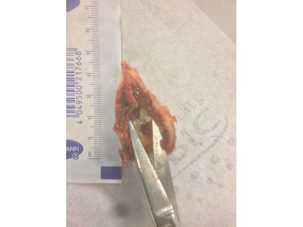 Интраоперационный материал: атеросклеротическая бляшка с атероматозом, изъязвлением и кровоизлиянием в строму