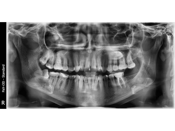 Ортопантомограмма: ретенированный зуб мудрости внизу слева