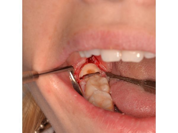 Разрез по вершине гребня от 48 до 46 зуба и отслоение лоскута