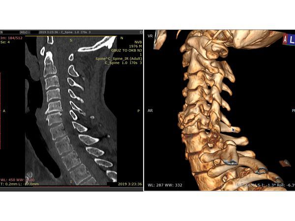Как делают кт шейного отдела позвоночника фото