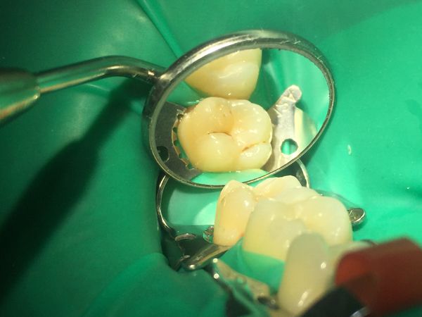 27 зуб до лечения