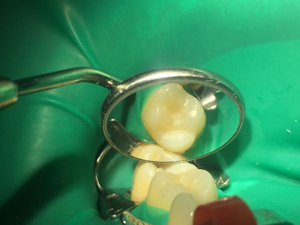 26 зуб после лечения