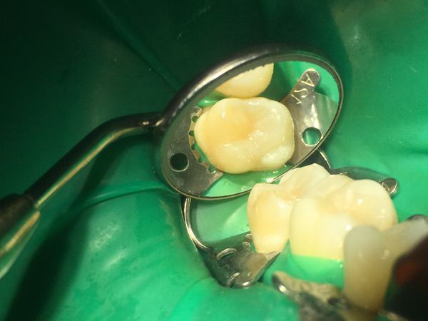 27 зуб после лечения