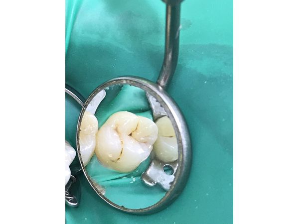 26 зуб до лечения