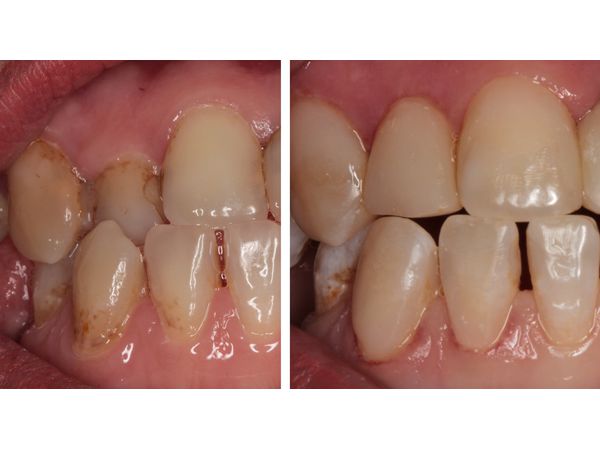 До и после лечения