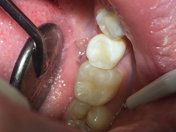 После лечения После лечения