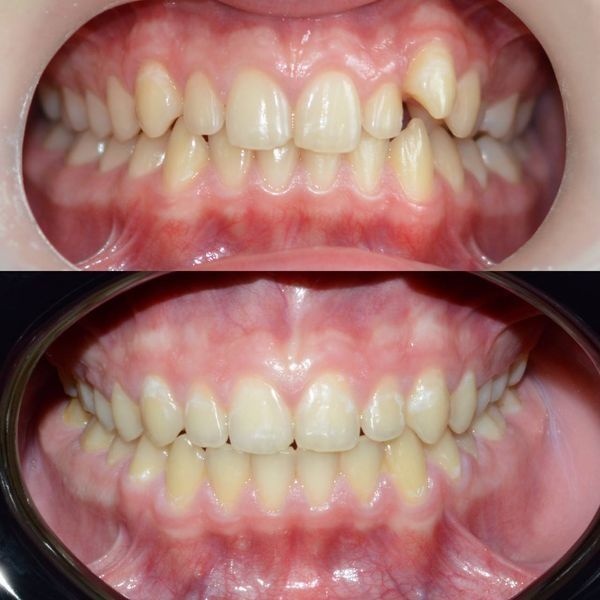 До и после лечения