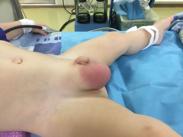 Локальный статус пациента с ущемлённой пахово-мошоночной грыжей