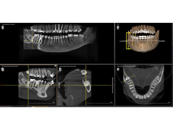 Компьютерная томография до удаления 48-го зуба 