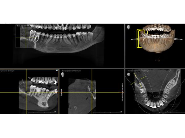 Компьютерная томография после удаления 48-го зуба