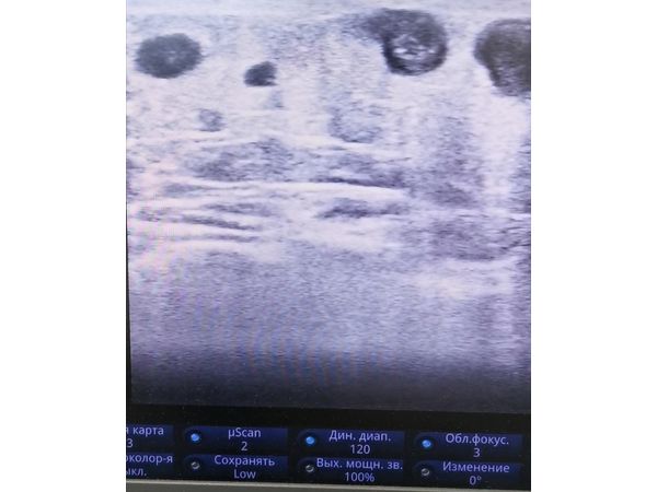 Белые включения на тёмном фоне — тромбы Белые включения на тёмном фоне — тромбы