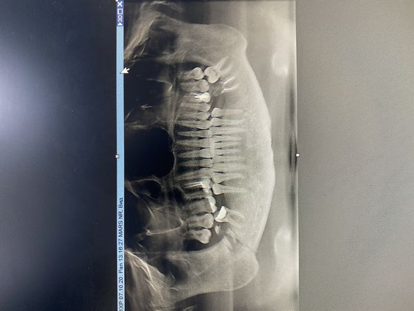 Ортопантомограмма нижней челюсти Ортопантомограмма нижней челюсти