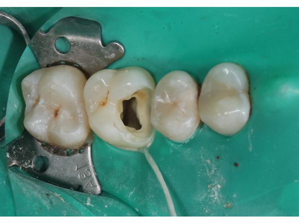 Процесс лечения. Зуб 1.6 после препарирования и витальной ампутации пульпы.