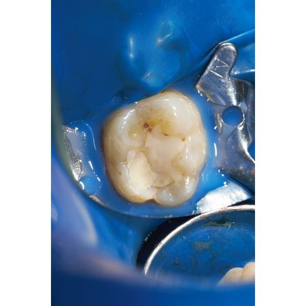 Этап пломбировки