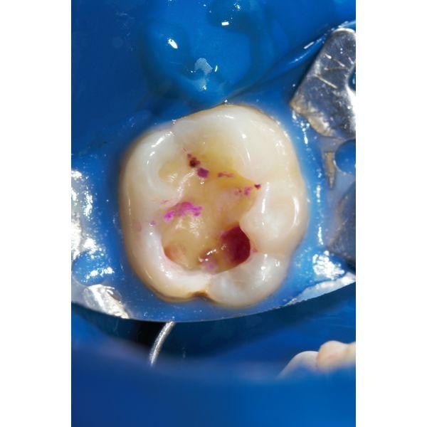 Полость зуба