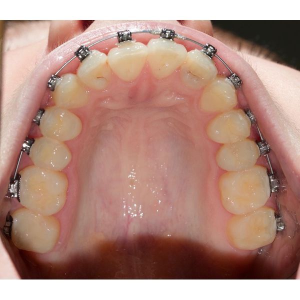 Установка брекетов