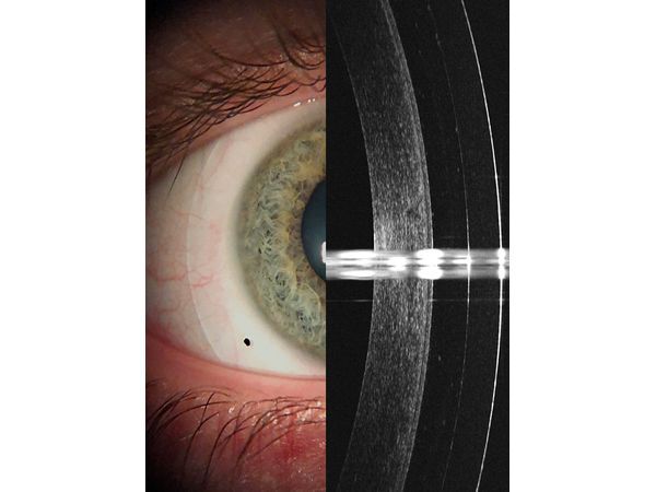 Склеральная линза на глазу и ОКТ снимок с оптимальным клиренсом (расстоянием между задней поверхностью линзы и передней поверхностью роговицы)