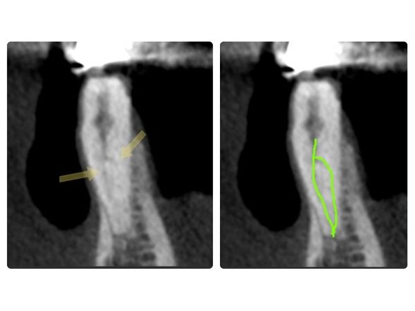 Анатомия корневых каналов зуба