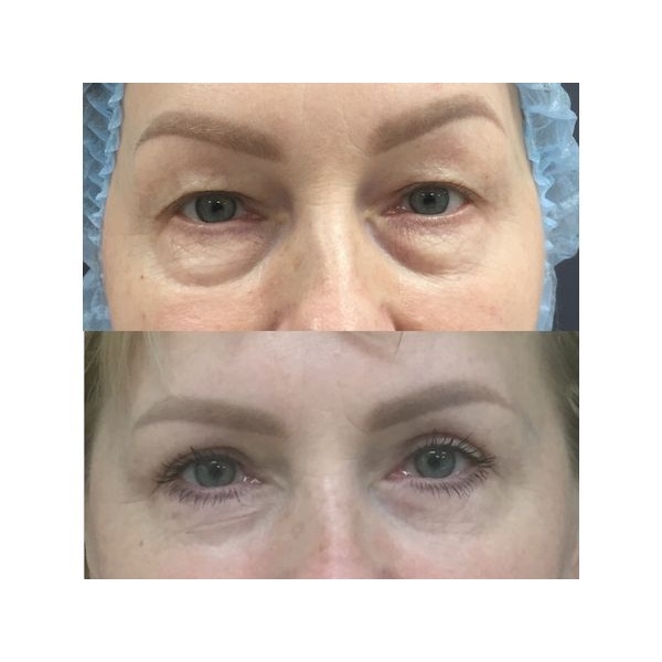 Через полгода после операции Через полгода после операции