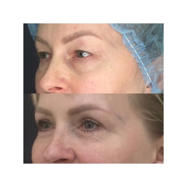 Через полгода после операции Через полгода после операции