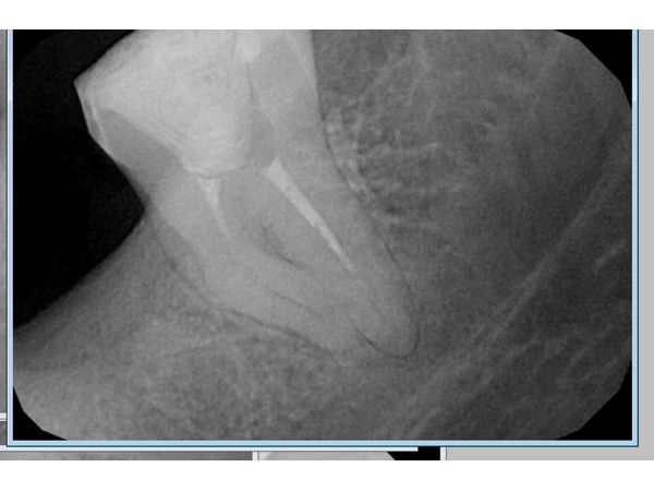 Рентгенограмма до лечения Рентгенограмма до лечения